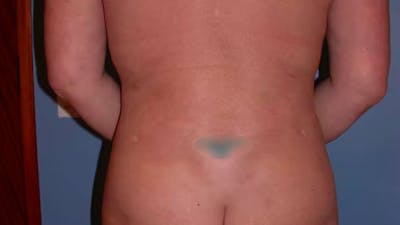 Liposuction Before & After Gallery - Patient 4752169 - Image 10