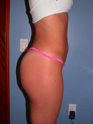 Patient 3 Female Liposuction Before & After