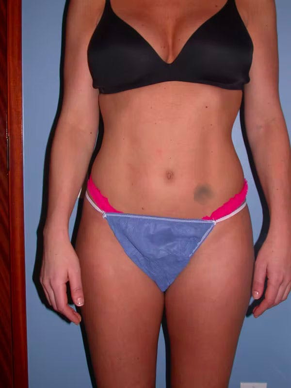 High Definition Liposuction Gallery Before & After Gallery - Patient 15928688 - Image 3
