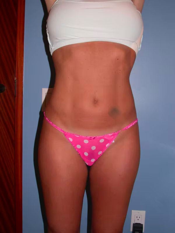 High Definition Liposuction Gallery Before & After Gallery - Patient 15928688 - Image 4