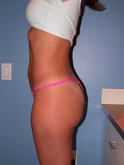 High Definition Liposuction Gallery Before & After Gallery - Patient 15928688 - Image 6