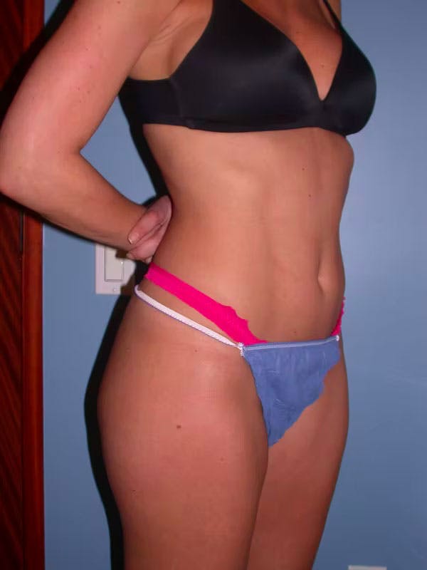Liposuction Gallery Before & After Gallery - Patient 4752210 - Image 7