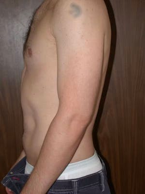 Patient 4 Male Liposuction Before & After