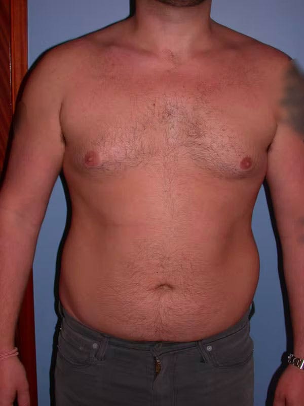 Male Liposuction Before & After Gallery - Patient 6097152 - Image 1