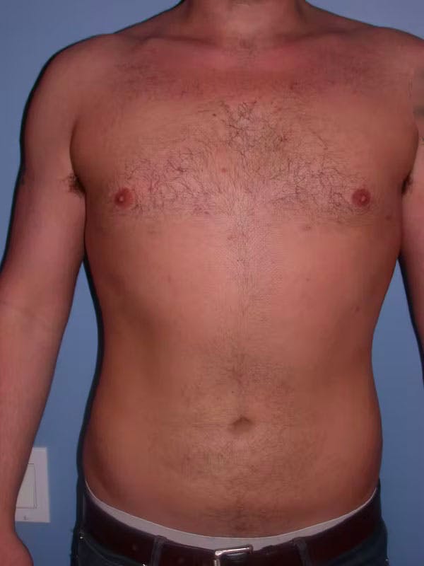 Male Liposuction Before & After Gallery - Patient 6097152 - Image 2