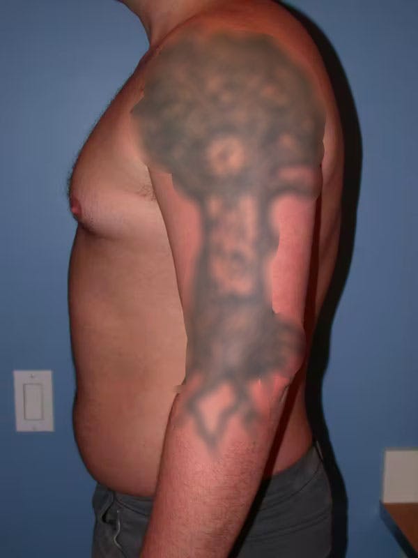 Male Liposuction Gallery Before & After Gallery - Patient 6097152 - Image 3