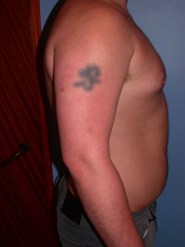 Male Liposuction Before & After Gallery - Patient 6097152 - Image 5
