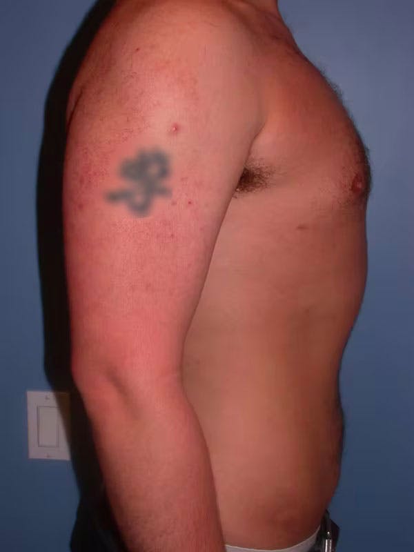 Male Liposuction Gallery Before & After Gallery - Patient 6097152 - Image 6