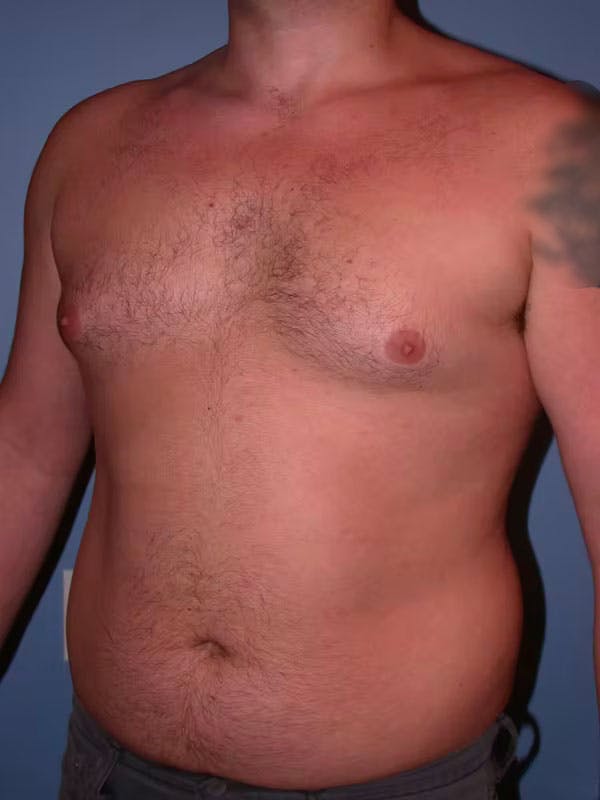 Male Liposuction Gallery Before & After Gallery - Patient 6097152 - Image 7