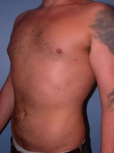 Male Liposuction Gallery Before & After Gallery - Patient 6097152 - Image 8