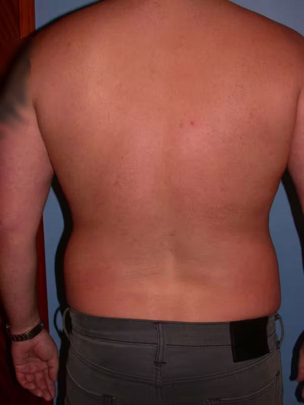 Male Liposuction Gallery Before & After Gallery - Patient 6097152 - Image 9