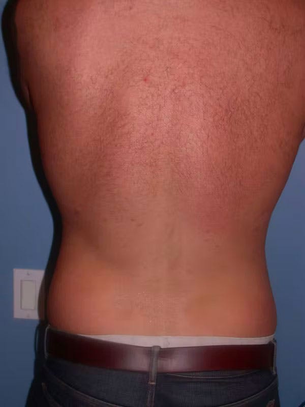Male Liposuction Before & After Gallery - Patient 6097152 - Image 10