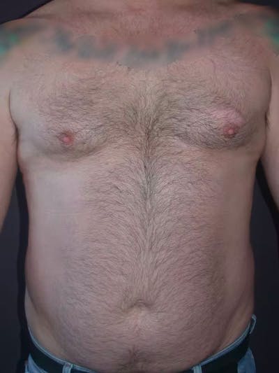 Male Liposuction Gallery Before & After Gallery - Patient 83153173 - Image 1