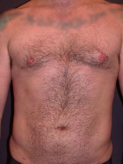 Male Liposuction Before & After Gallery - Patient 83153173 - Image 2