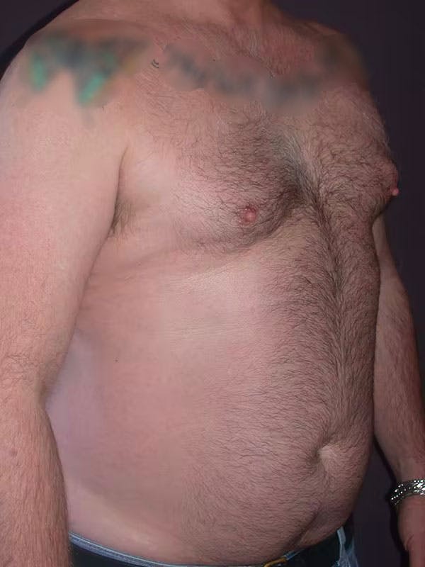 Male Liposuction Gallery Before & After Gallery - Patient 83153173 - Image 3