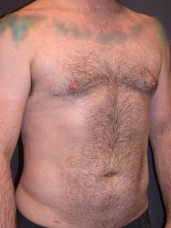 Male Liposuction Gallery Before & After Gallery - Patient 83153173 - Image 4