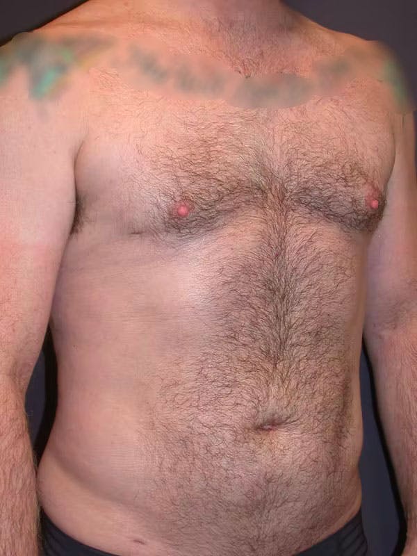 Male Liposuction Gallery Before & After Gallery - Patient 83153173 - Image 4