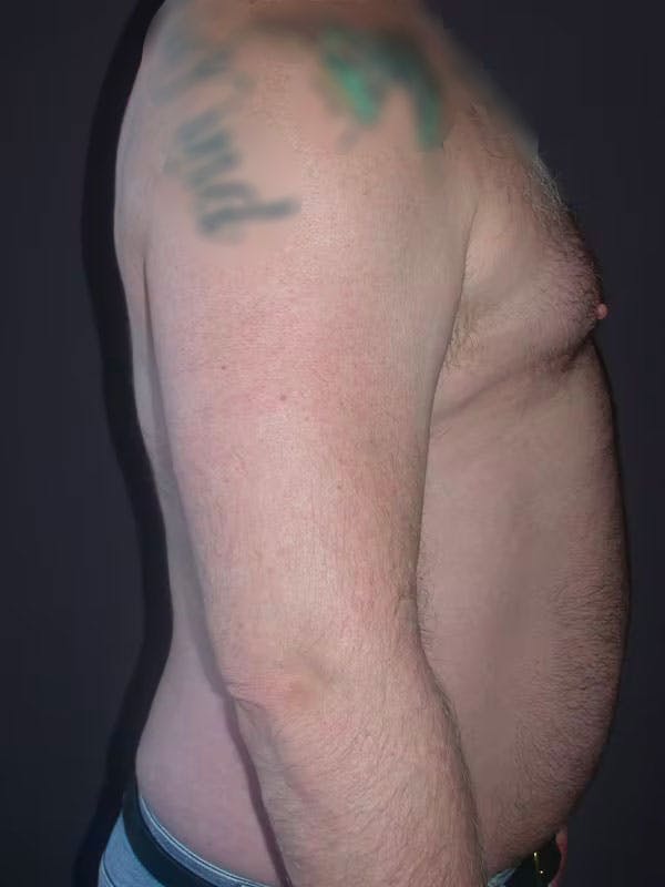 Male Liposuction Before & After Gallery - Patient 83153173 - Image 5