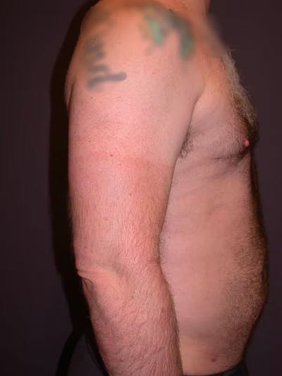 Male Liposuction Gallery Before & After Gallery - Patient 83153173 - Image 6