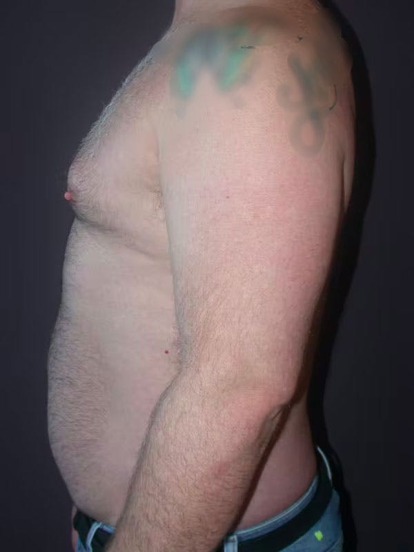 Male Liposuction Before & After Gallery - Patient 83153173 - Image 7