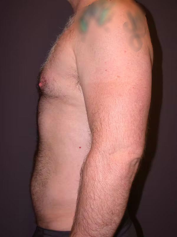 Male Liposuction Gallery Before & After Gallery - Patient 83153173 - Image 8