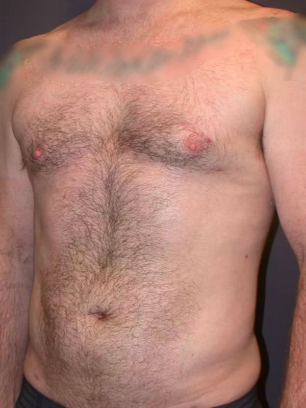 Male Liposuction Before & After Gallery - Patient 83153173 - Image 10