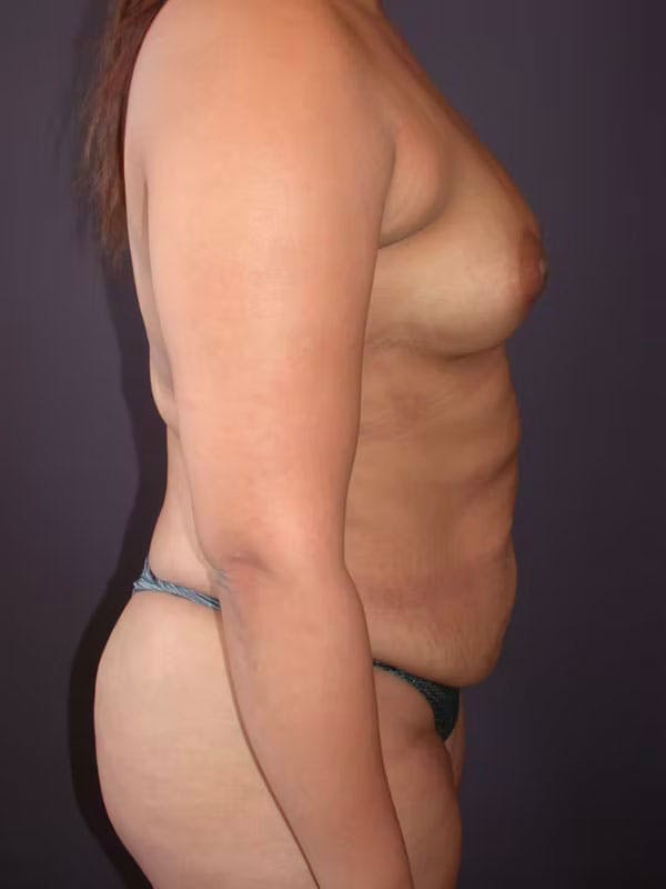 Tummy Tuck Gallery Before & After Gallery - Patient 40633059 - Image 5