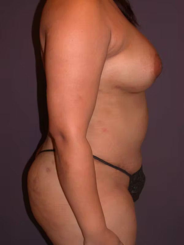 Tummy Tuck Gallery Before & After Gallery - Patient 40633059 - Image 6