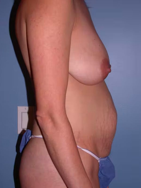 Mommy Makeover Before & After Gallery - Patient 4752230 - Image 3