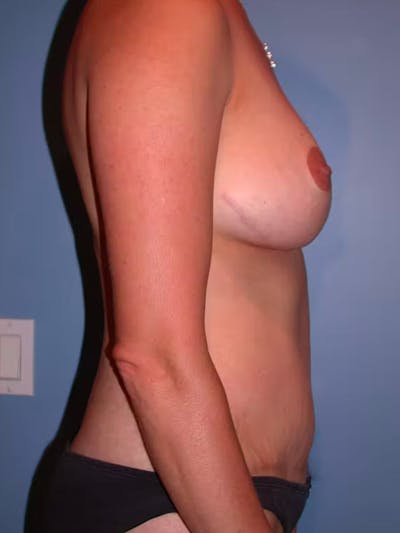 Mommy Makeover Before & After Gallery - Patient 4752230 - Image 4