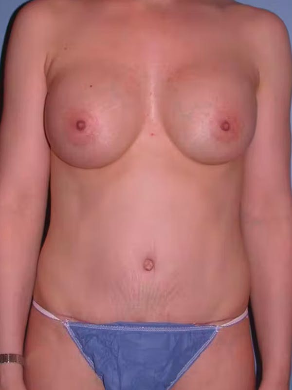 Mommy Makeover Before & After Gallery - Patient 4752232 - Image 2