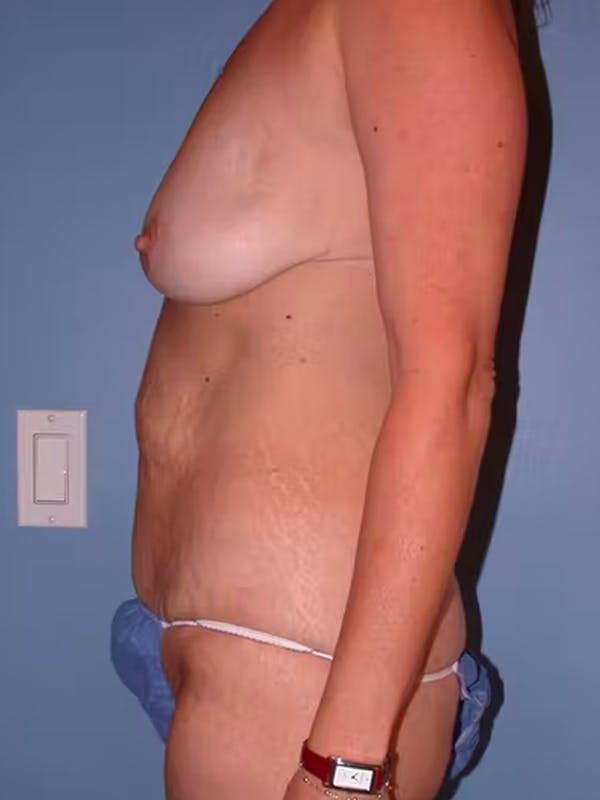 Mommy Makeover Gallery - Patient 4752234 - Image 3
