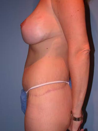Mommy Makeover Before & After Gallery - Patient 4752234 - Image 4