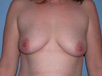 Breast Augmentation Before & After Gallery - Patient 4757358 - Image 1