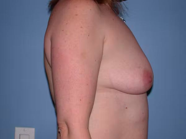 Breast Augmentation Gallery Before & After Gallery - Patient 4757358 - Image 3
