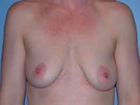 Breast Augmentation Before & After Gallery - Patient 4757611 - Image 1