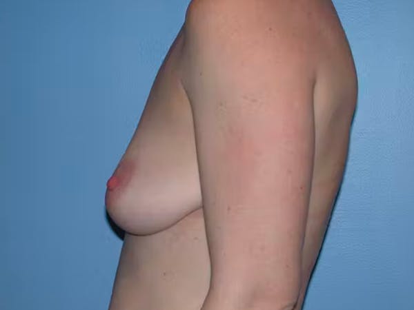 Breast Augmentation Gallery Before & After Gallery - Patient 4757611 - Image 3