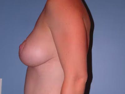 Breast Augmentation Before & After Gallery - Patient 4757611 - Image 4
