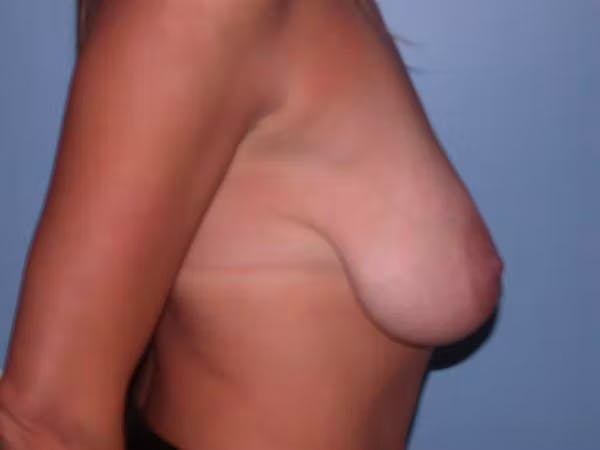Breast Lift Gallery Before & After Gallery - Patient 6406821 - Image 5