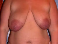 Breast Reduction Gallery Before & After Gallery - Patient 4757222 - Image 1