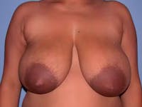 Breast Reduction Gallery Before & After Gallery - Patient 4757238 - Image 1