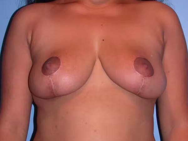 Breast Reduction Gallery Before & After Gallery - Patient 4757238 - Image 2