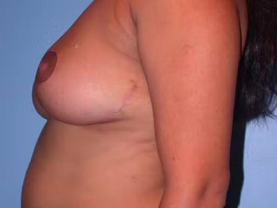Breast Reduction Before & After Gallery - Patient 4757238 - Image 6