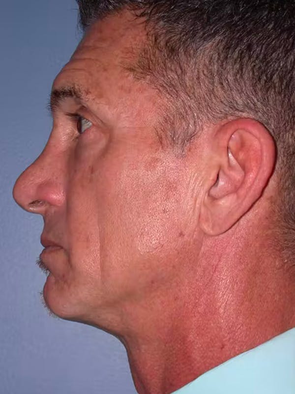 BOTOX Gallery Before & After Gallery - Patient 4756860 - Image 3