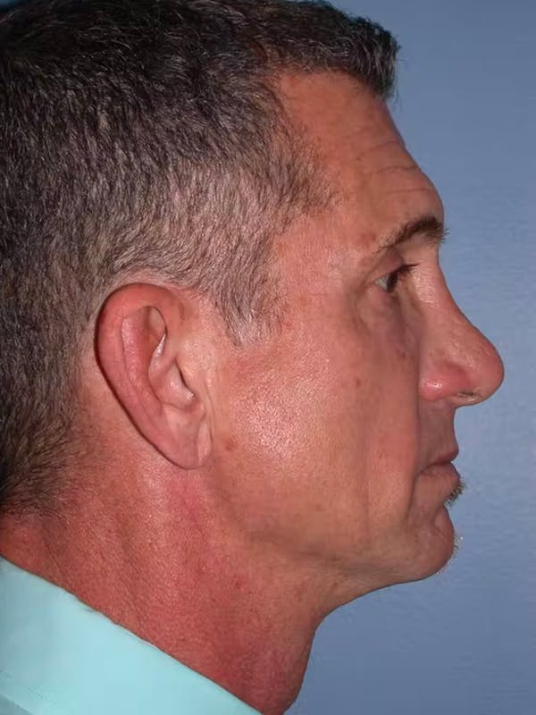 BOTOX Gallery Before & After Gallery - Patient 4756860 - Image 5