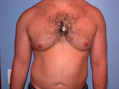 Male Liposuction Gallery Before & After Gallery - Patient 6097150 - Image 1