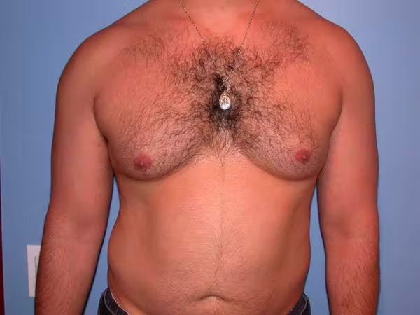 Male Liposuction Gallery Before & After Gallery - Patient 6097150 - Image 1