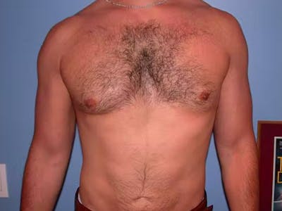 Male Liposuction Gallery Before & After Gallery - Patient 6097150 - Image 2