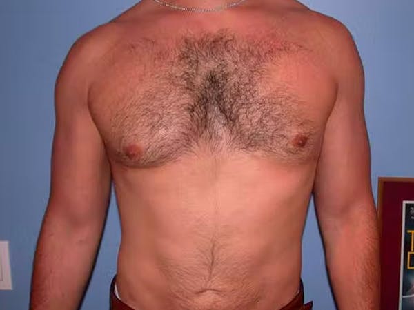 Male Liposuction Before & After Gallery - Patient 6097150 - Image 2