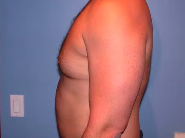 Male Liposuction Gallery Before & After Gallery - Patient 6097150 - Image 3